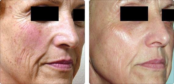 LASER FRACTIONAL SKIN RESURFACING